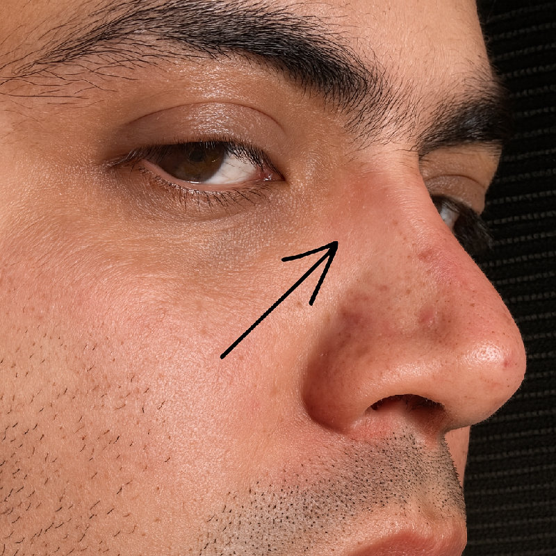 他整天戴着太阳镜后，鼻梁上留下了印记。