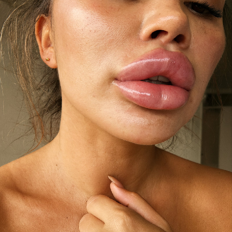 由于过敏反应，她的嘴唇肿了起来。