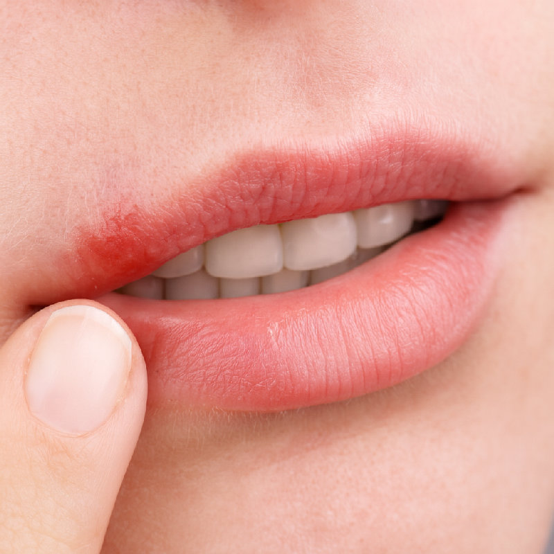 唇疱疹，也称为发热性疱疹，是由于病毒感染而在嘴唇上出现的。