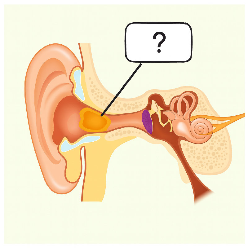 耳垢堵塞意味着耳道里堆积了过多的耳垢。