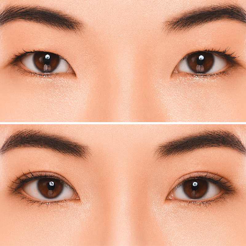 她做了双眼皮手术，现在眼睛看起来更大了。