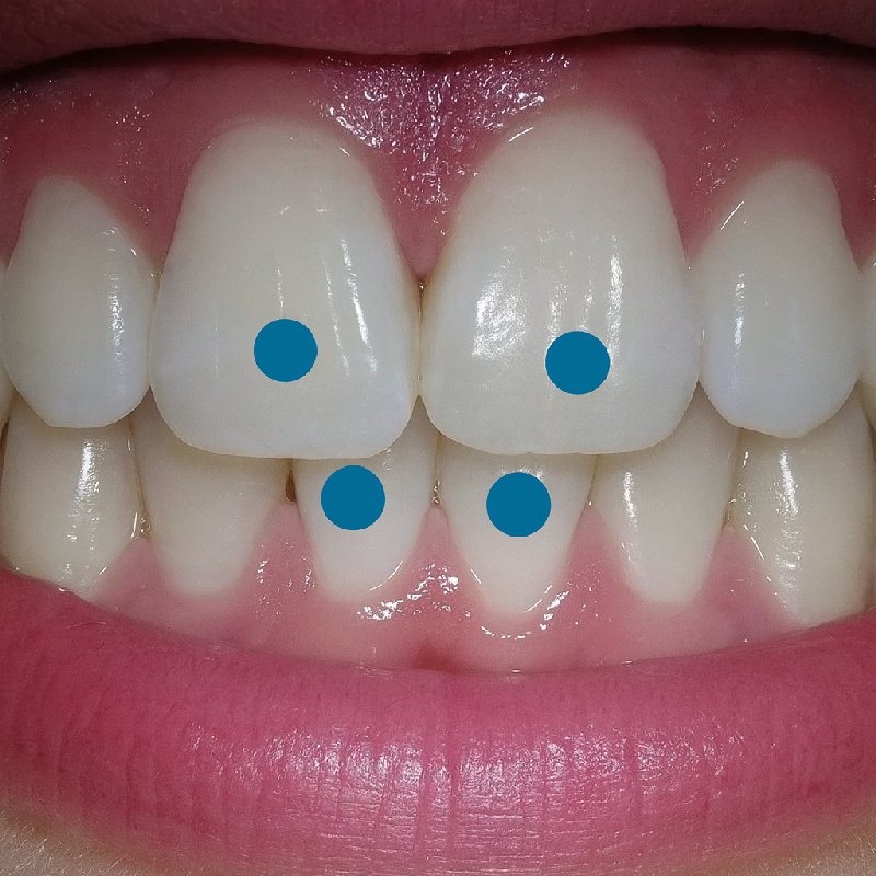 图中可以看到四颗被标记的门牙。