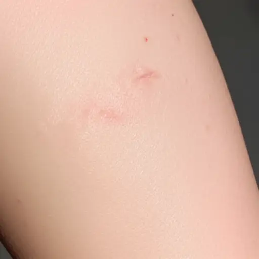 这次受伤给他留下了一道永久的疤痕。