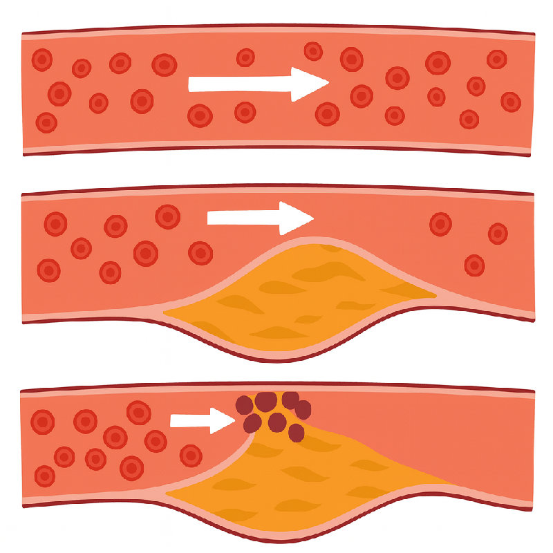 动脉中的斑块会增加心脏病风险。