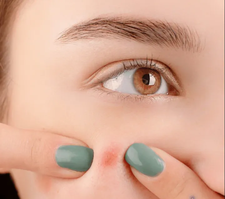 她的脸上有一个红色痘痘。