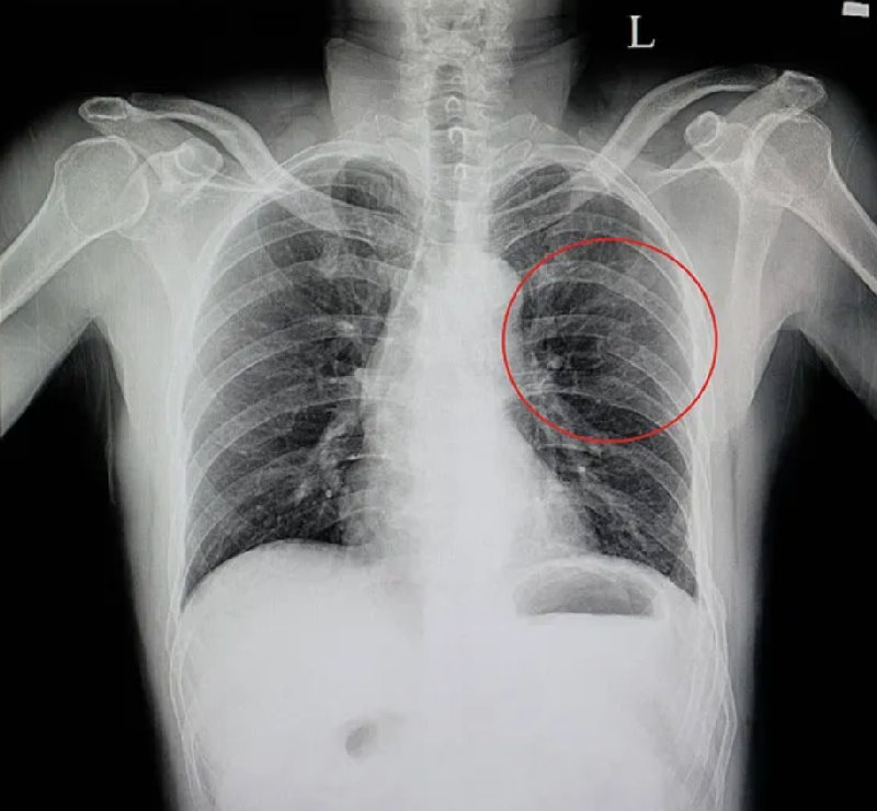 X光显示肋骨有骨折。