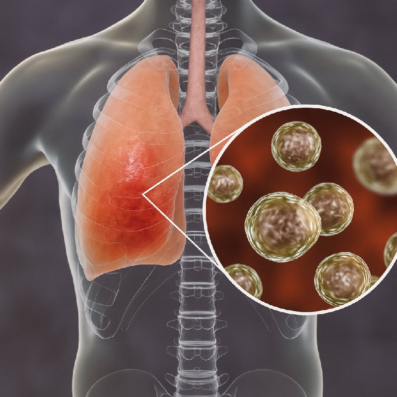 他的肺有感染。