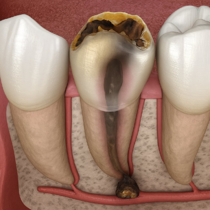 他有一颗蛀牙。