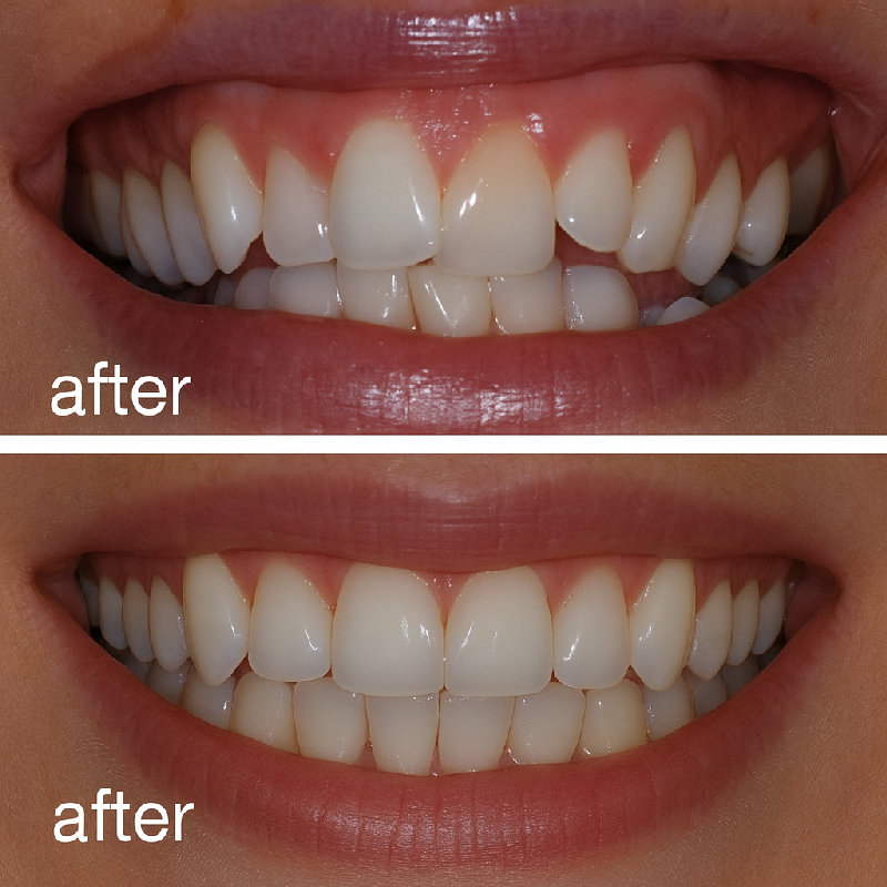 牙套帮助她拥有了整齐的牙齿。
