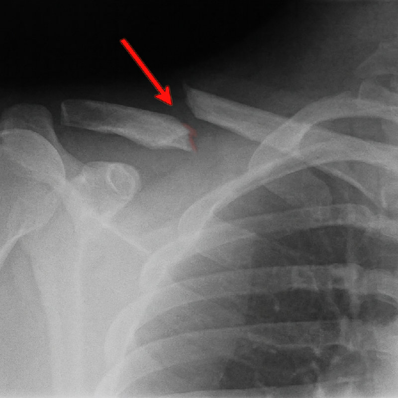 她的锁骨断了。