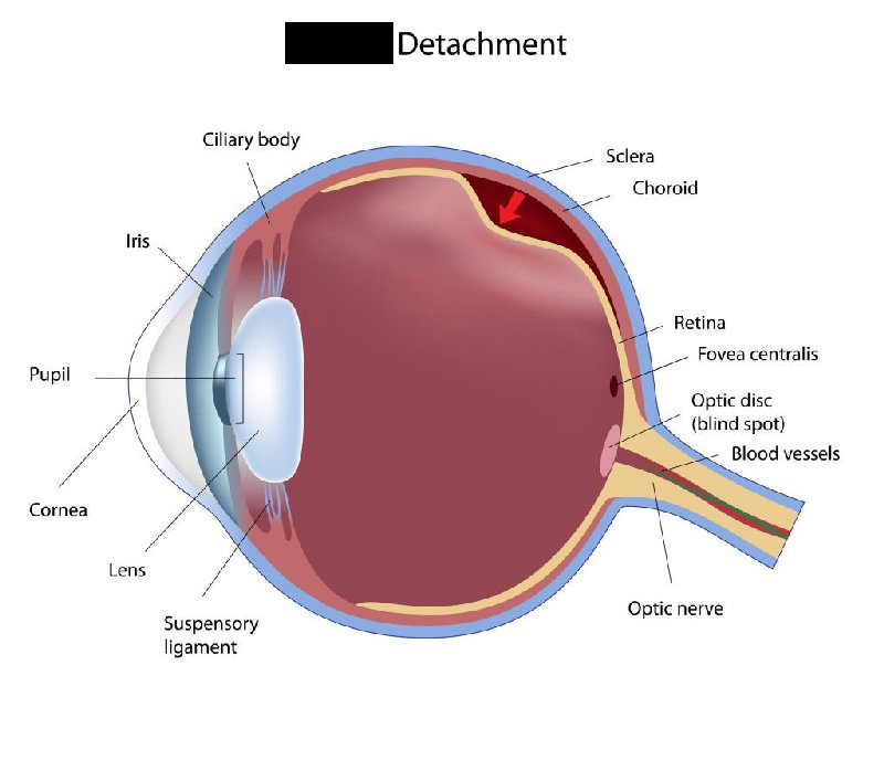 视网膜脱离的意思是视网膜在眼睛里松脱了